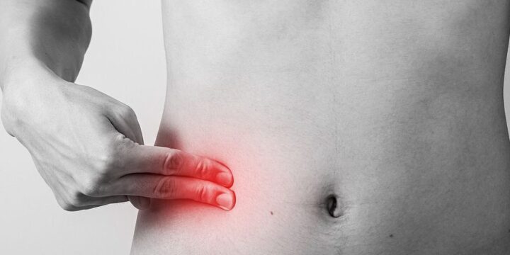 Гострий апендицит